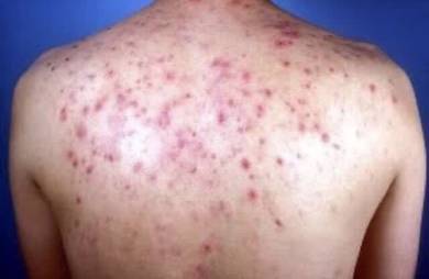 Anti fungal cream zix cosix + wild aloe vera 15g